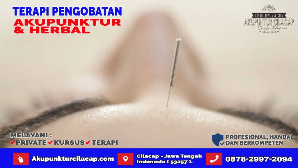Terapi Akupuntur di Wanareja