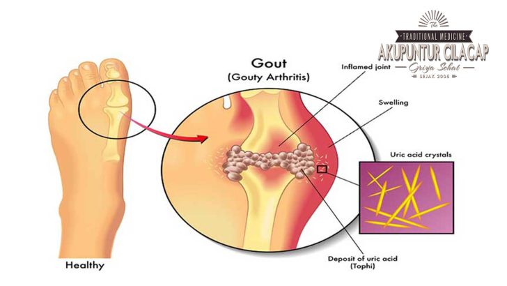Akupunktur untuk Asam Urat