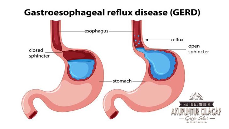 Akupunktur untuk GERD