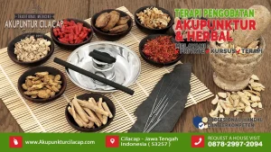 Akupunktur untuk Migrain