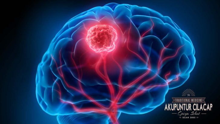 Akupunktur untuk Tumor Otak