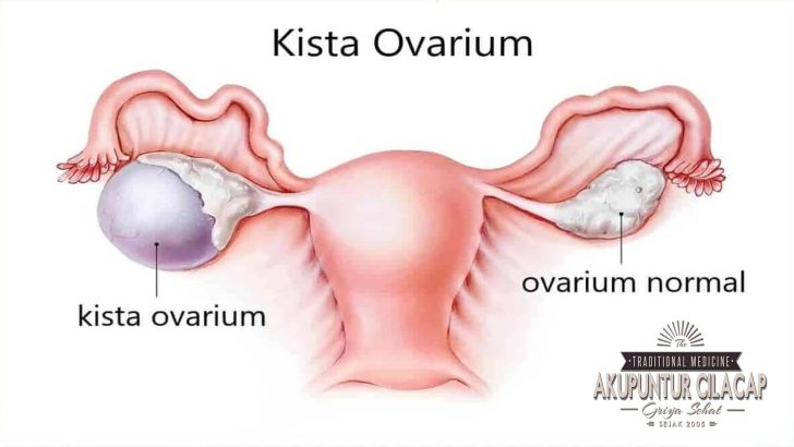Akupunktur untuk Kista