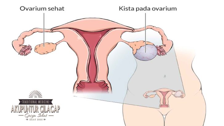 Titik Akupunktur untuk Kista Rahim
