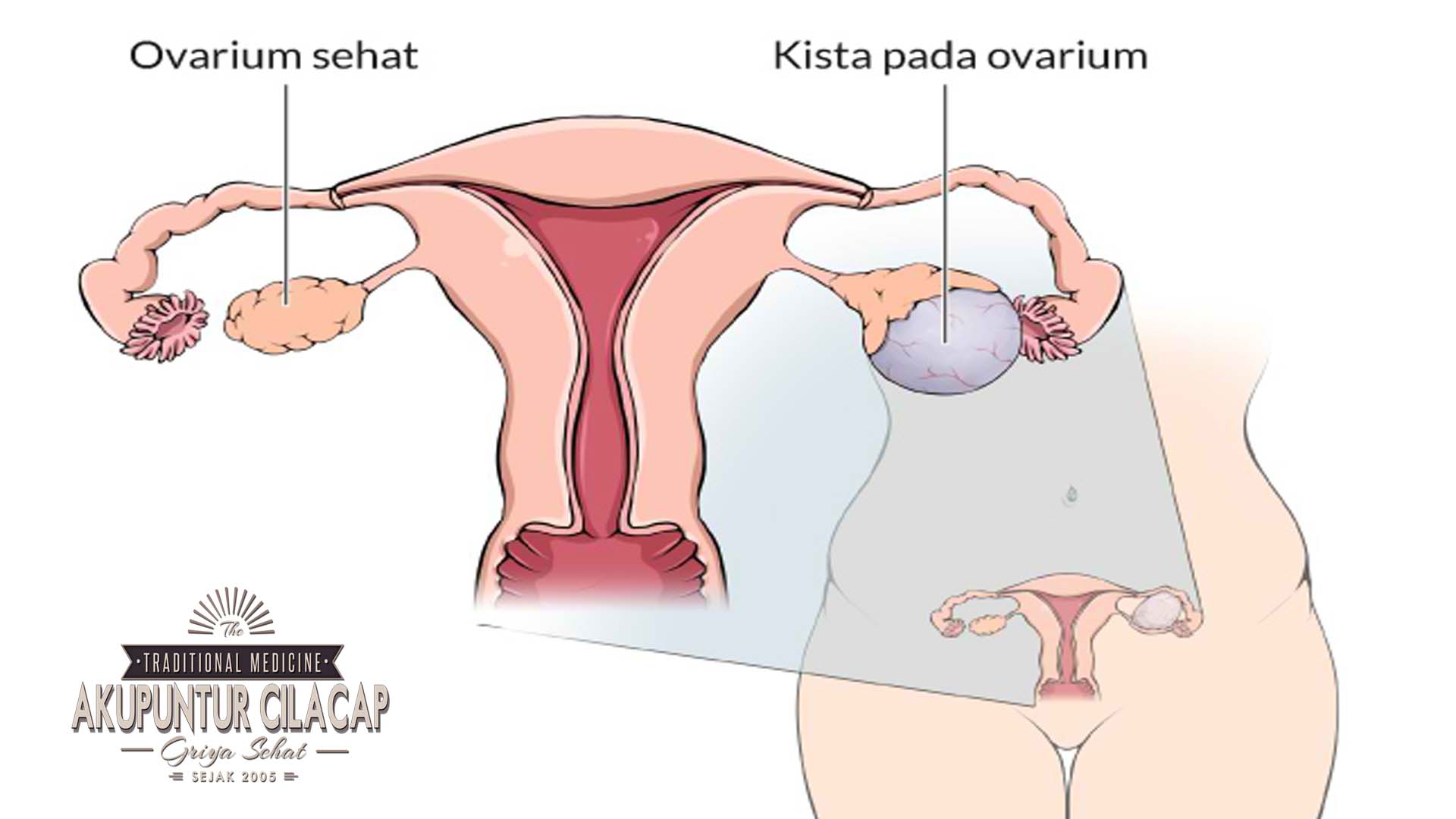 Titik Akupunktur untuk Kista Rahim Titik Akupunktur untuk Kista Rahim