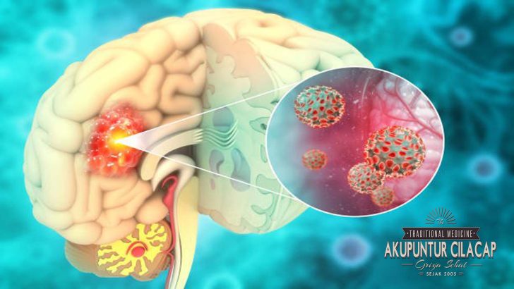 Titik Akupunktur untuk Tumor Otak
